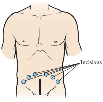 laparoscopic prostate