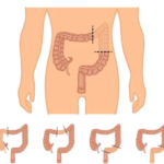 Bowel Resection