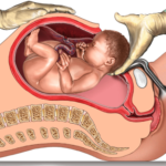 C-Section (Cesarean Section)