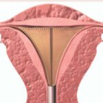 Endometrial Ablation