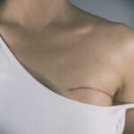 Mastectomy